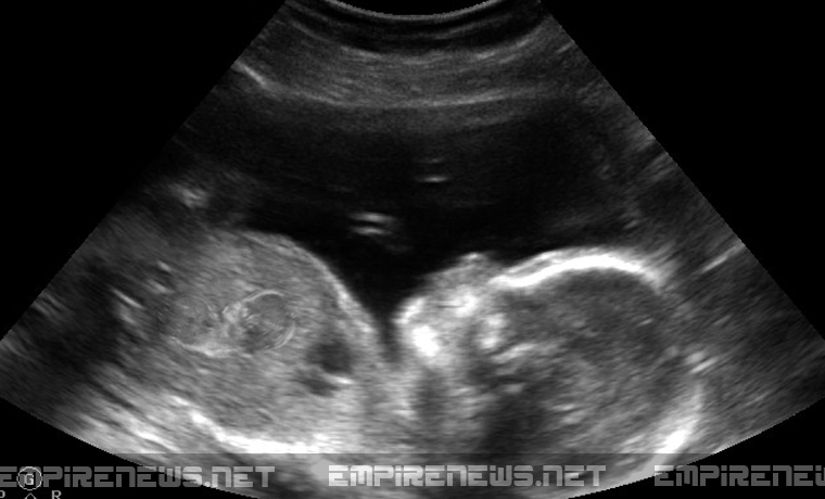 Fake Unborn Baby Sonogram. (Empire News)